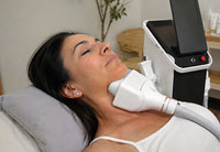 Cryolipolyse menton avec cryocell 360 IA